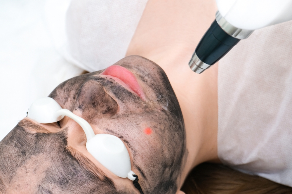 Carbon Peeling behandeling