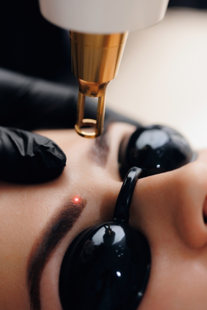 PMU verwijdering behandeling