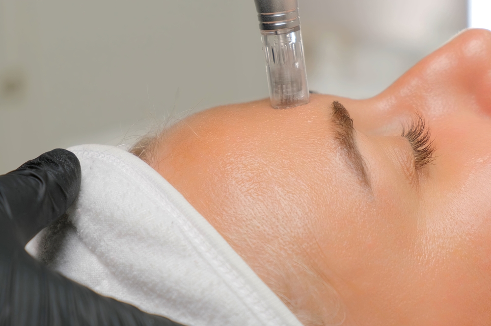 Microneedling behandeling